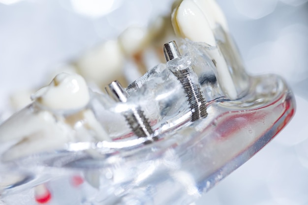 Dental Implants