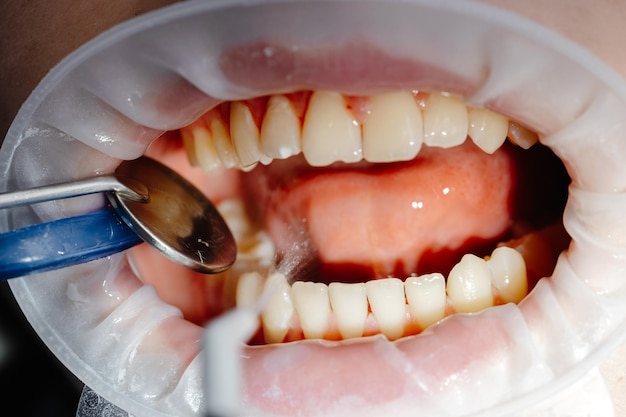 Gum Disease Treatment